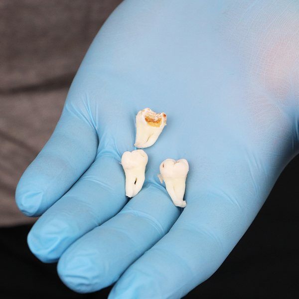 Hand holding three extracted teeth