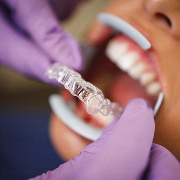 Dentist in Virginia Beach placing Invisalign tray on patient
