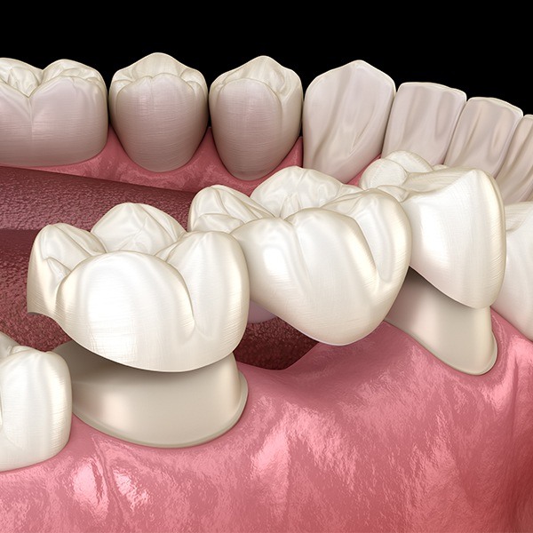 Animated smile during dental bridge tooth replacement