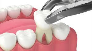 Tooth Extractions in Virginia Beach