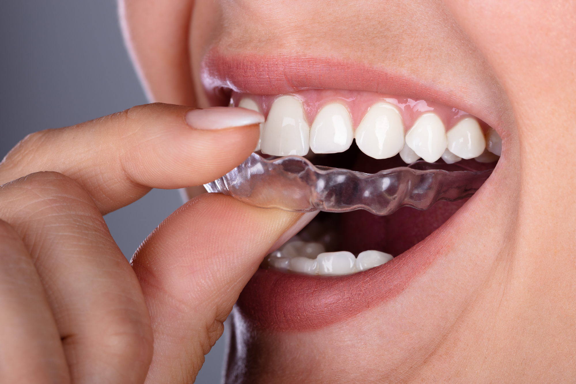 Clear Aligners Lifespan: How Long They Last