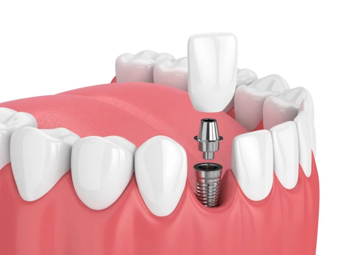 Benefits of Dental Implants in Virginia Beach, VA