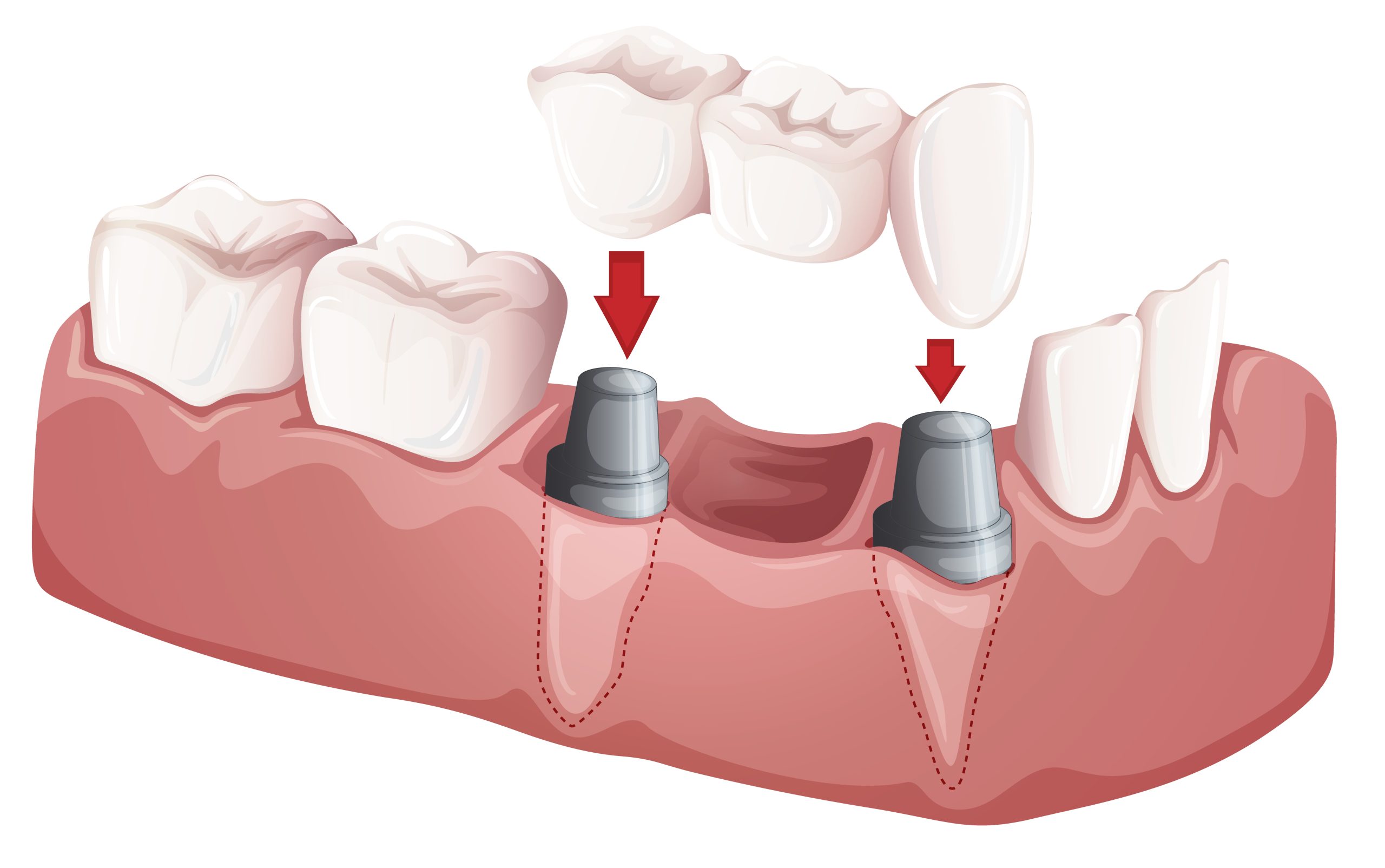 Dental Bridges for Missing Teeth: A Reliable Way to Restore Your Smile
