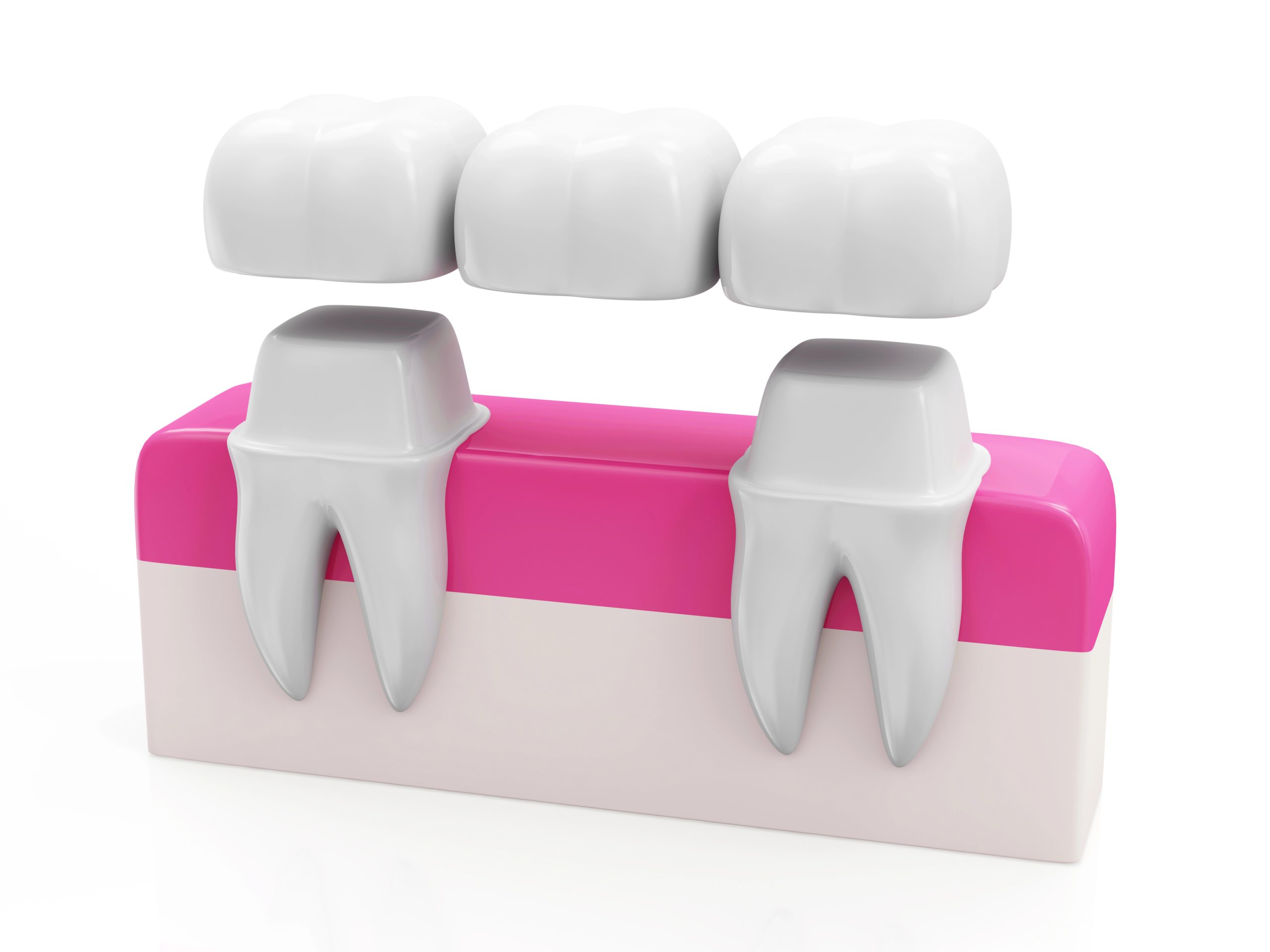 Affordable Dental Bridges Near Me: How to Find Cost-Effective Tooth Replacement